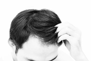 Hair Transplants vs. PRIMAL HAIR